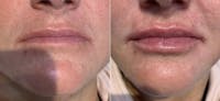 Fillers Before & After Gallery - Patient 467707 - Image 1