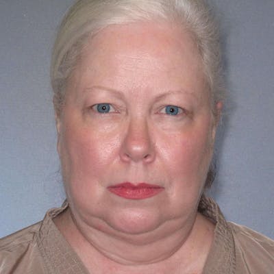 Facelift Before & After Gallery - Patient 172345 - Image 1