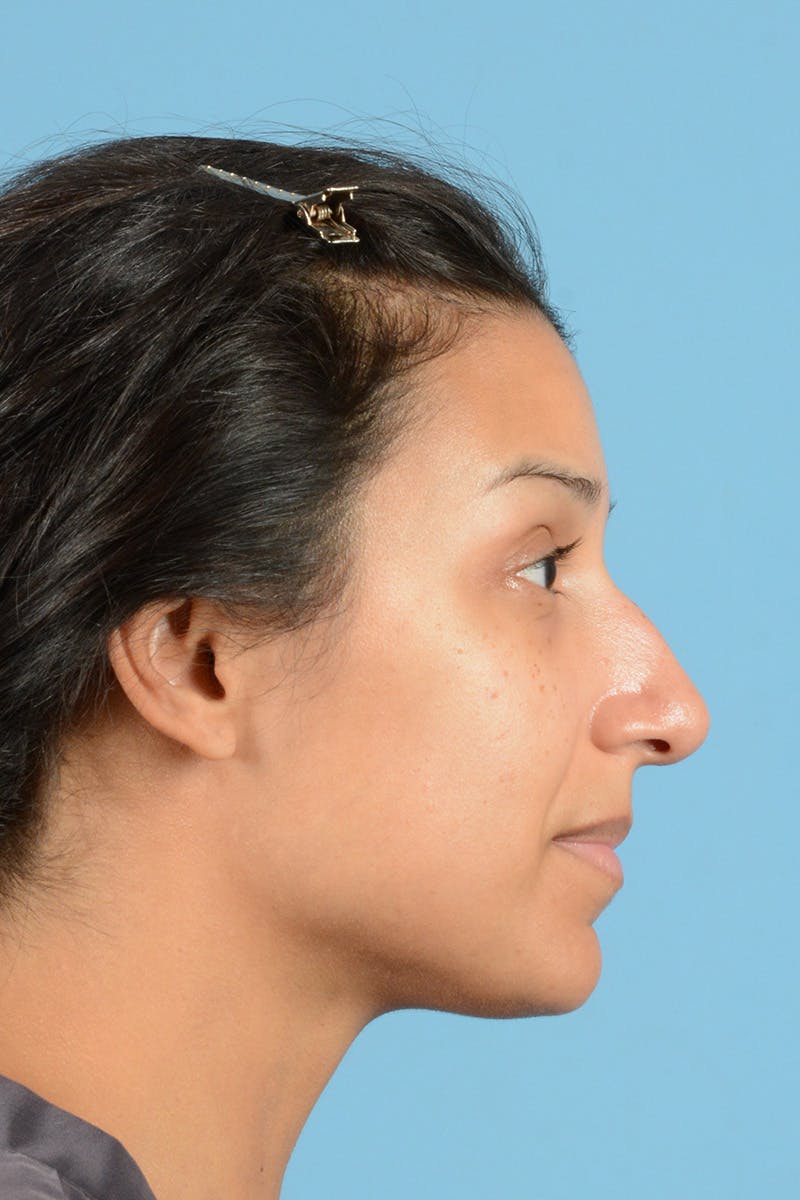 Rhinoplasty Before & After Gallery - Patient 177071 - Image 5