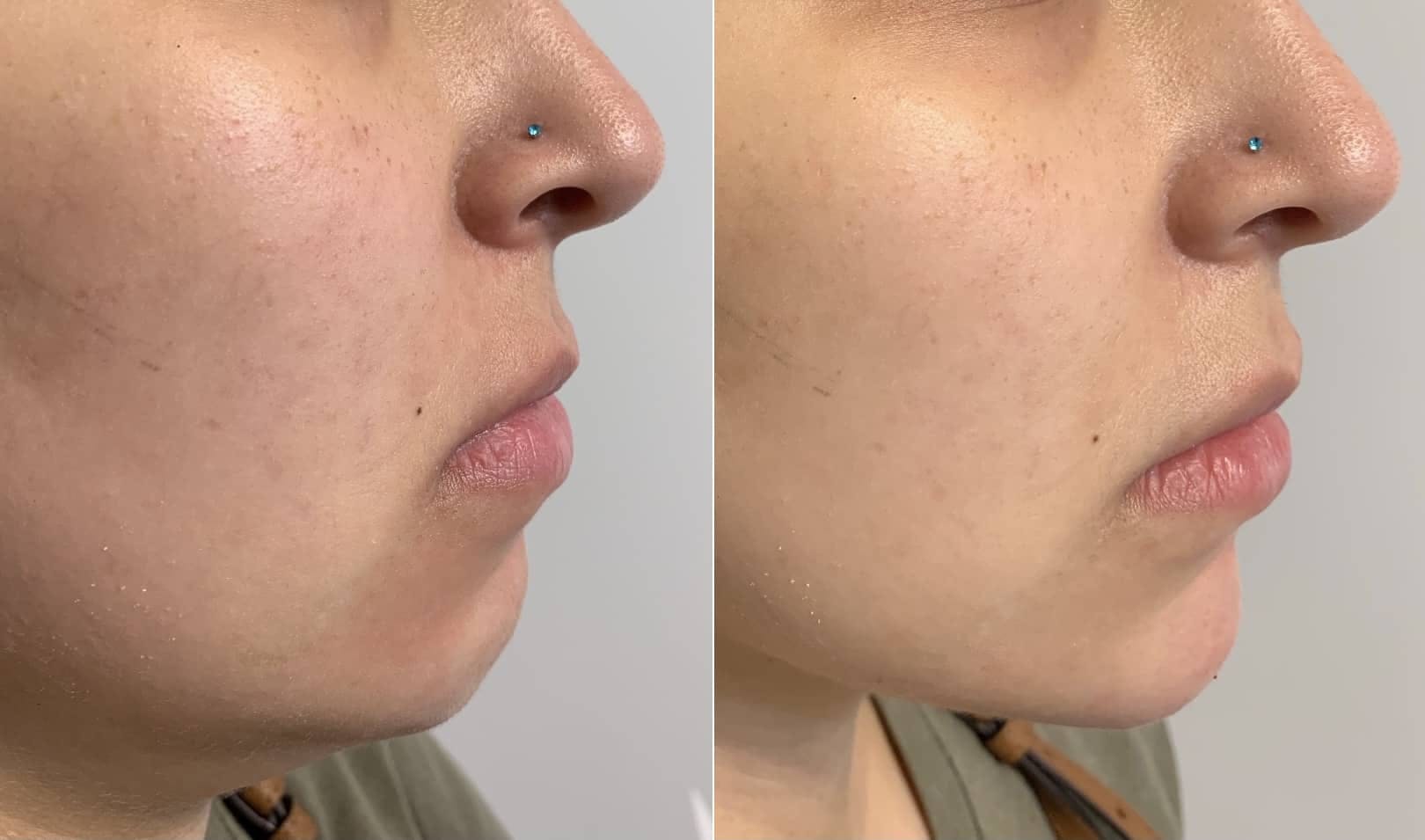 Fillers Before & After Gallery - Patient 384970 - Image 1