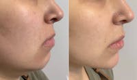 Fillers Before & After Gallery - Patient 384970 - Image 1