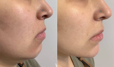 Fillers Before & After Gallery - Patient 384970 - Image 1