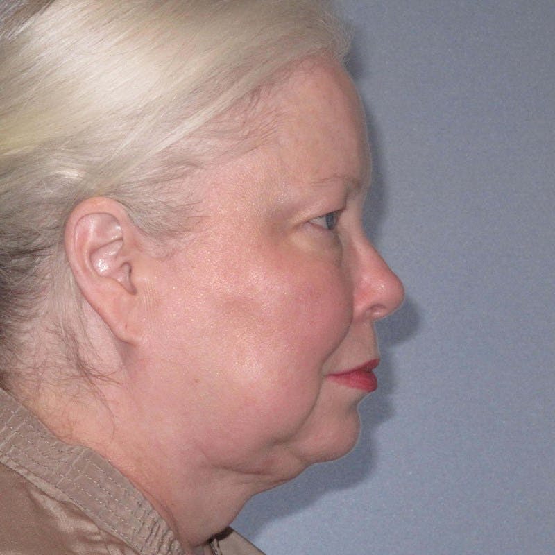 Facelift Before & After Gallery - Patient 172345 - Image 3