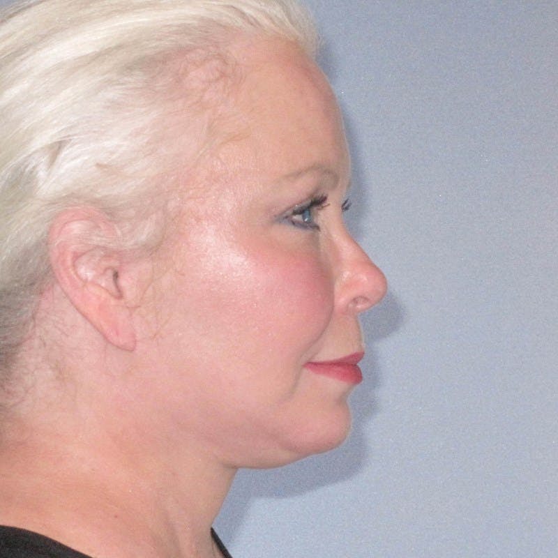 Facelift Before & After Gallery - Patient 172345 - Image 4