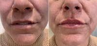 Fillers Before & After Gallery - Patient 556308 - Image 1