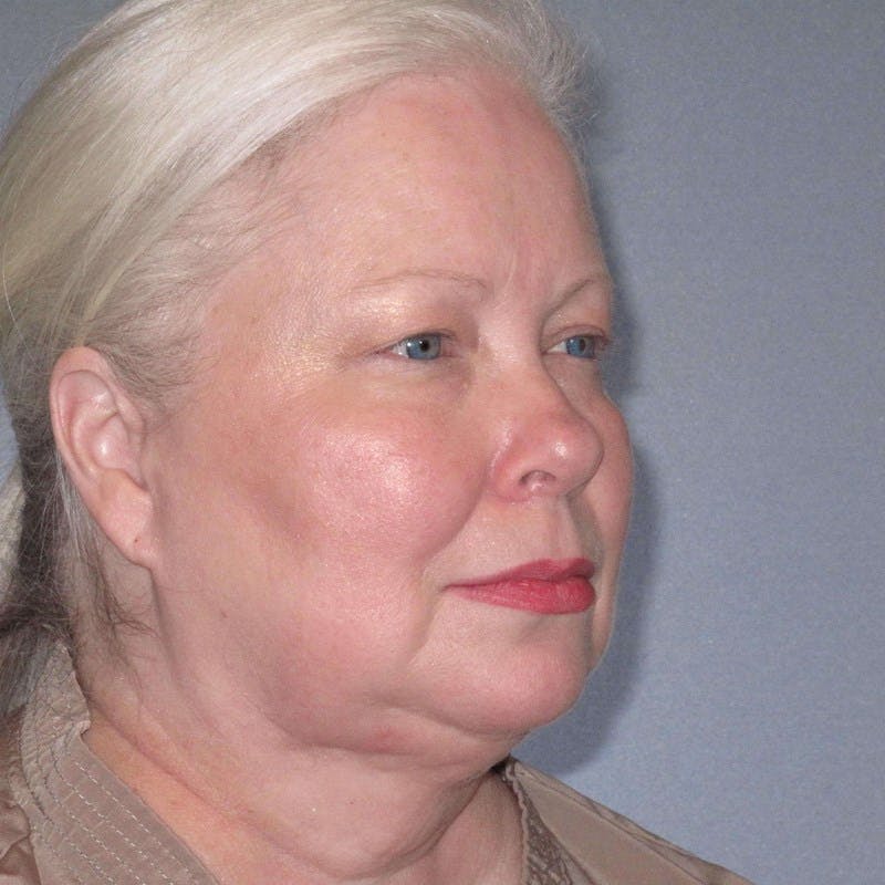 Facelift Before & After Gallery - Patient 172345 - Image 5