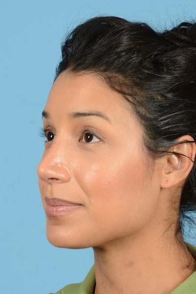 Rhinoplasty Before & After Gallery - Patient 177071 - Image 8