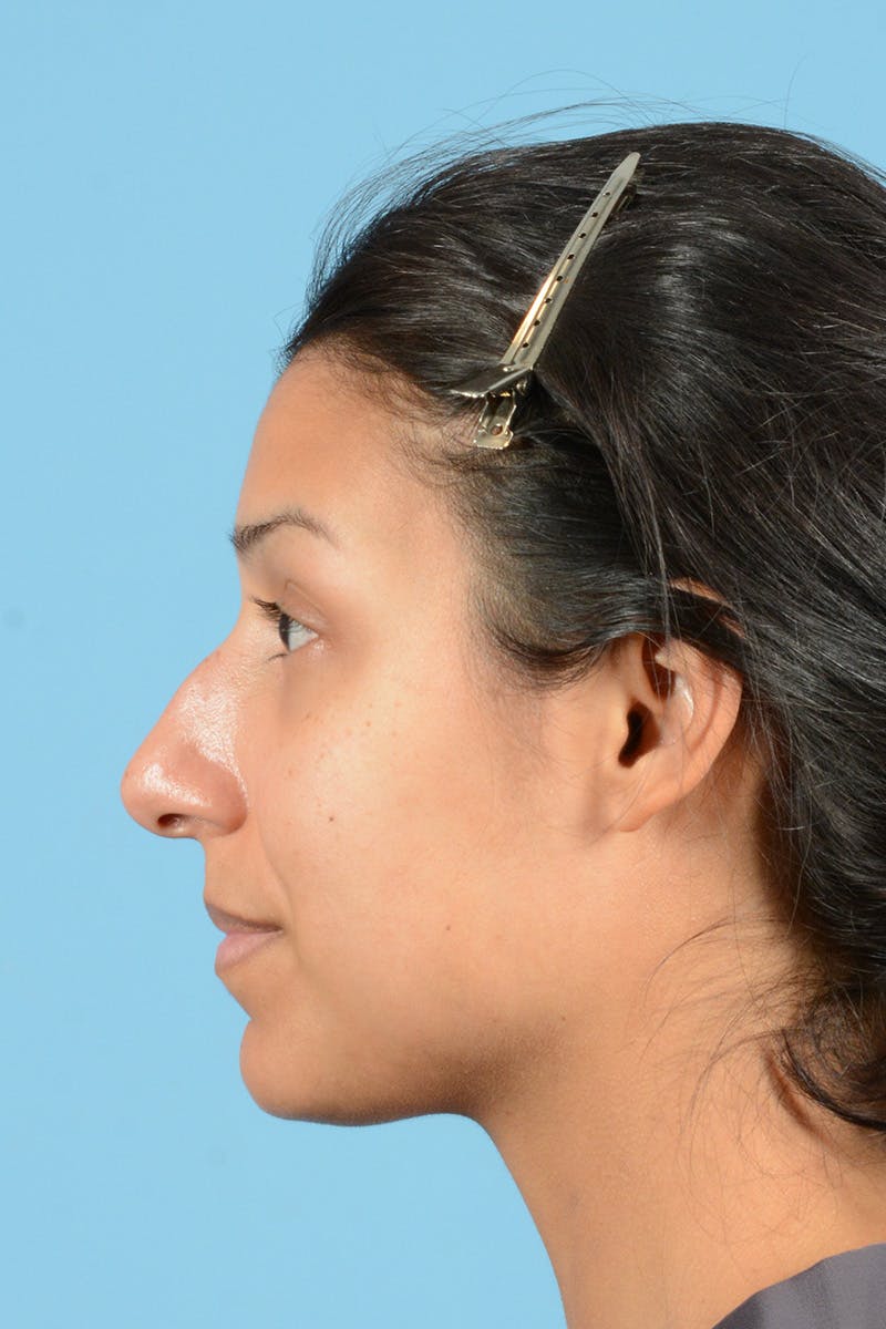 Rhinoplasty Before & After Gallery - Patient 177071 - Image 9