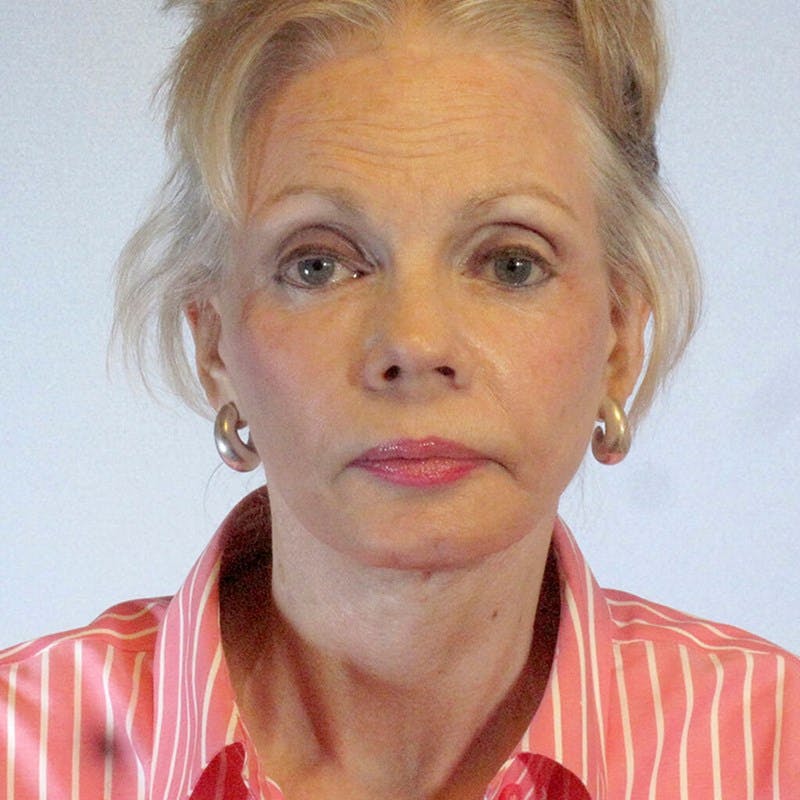 Facelift Before & After Gallery - Patient 182808 - Image 2