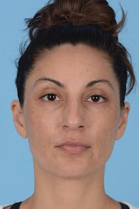 Rhinoplasty Before & After Gallery - Patient 256091 - Image 1