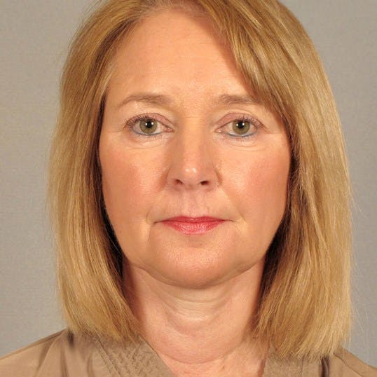 Neck Lift Before & After Gallery - Patient 140036 - Image 2