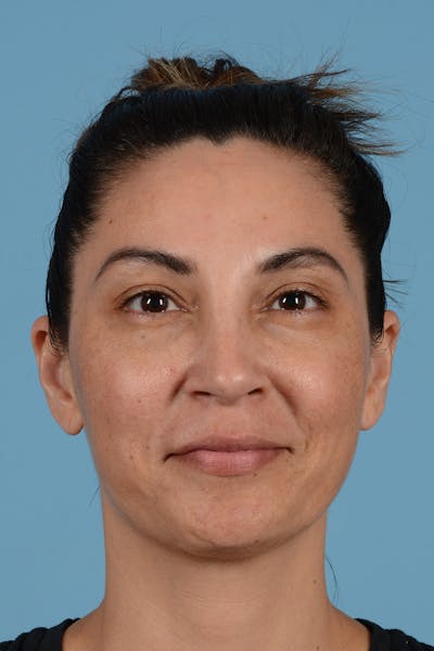 Rhinoplasty Before & After Gallery - Patient 256091 - Image 2