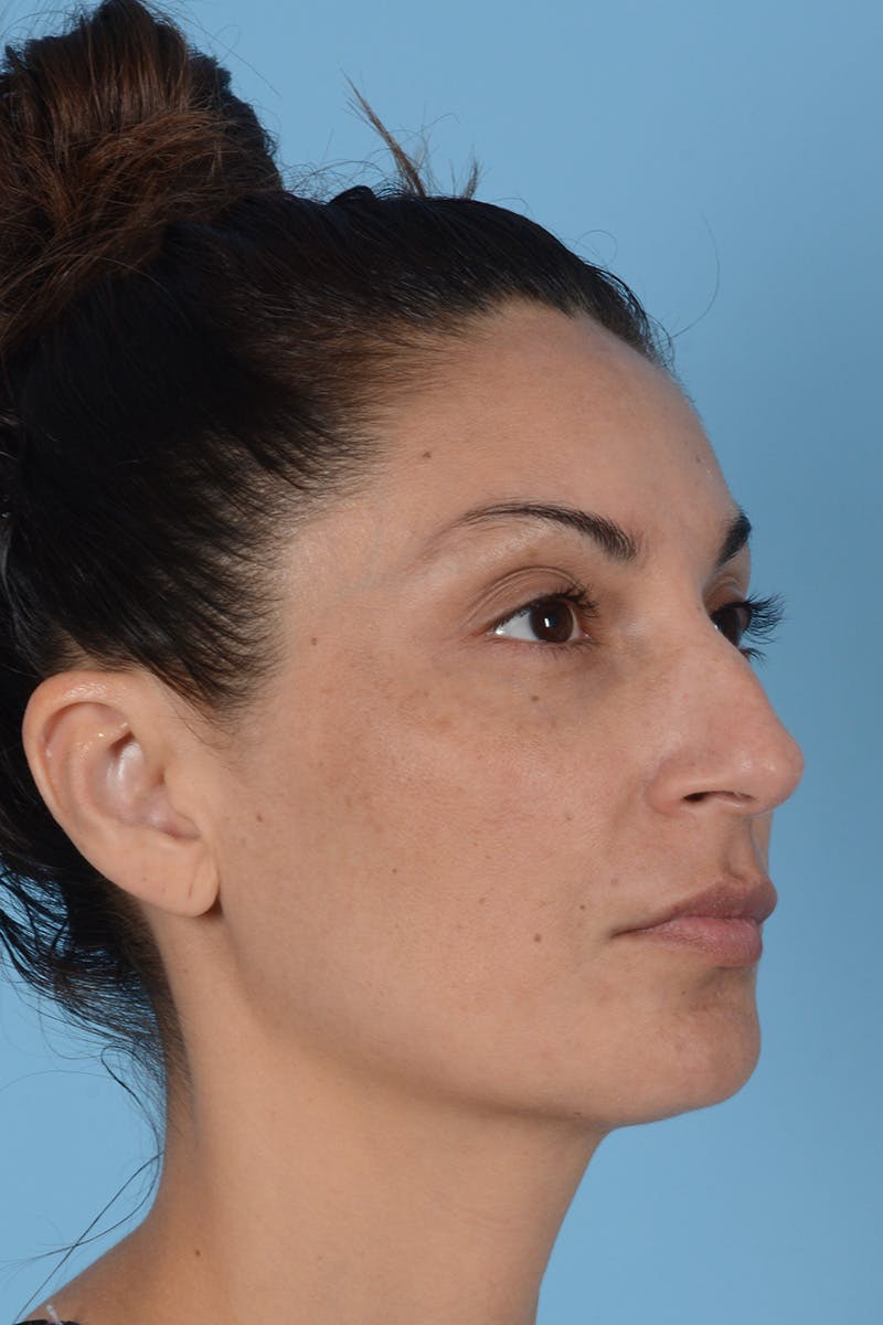 Rhinoplasty Before & After Gallery - Patient 256091 - Image 3