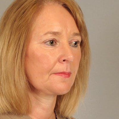 Neck Lift Before & After Gallery - Patient 140036 - Image 4