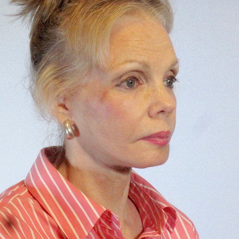Facelift Before & After Gallery - Patient 182808 - Image 4