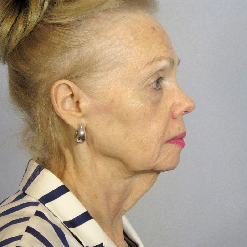 Facelift Before & After Gallery - Patient 182808 - Image 5
