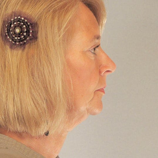 Neck Lift Before & After Gallery - Patient 140036 - Image 5