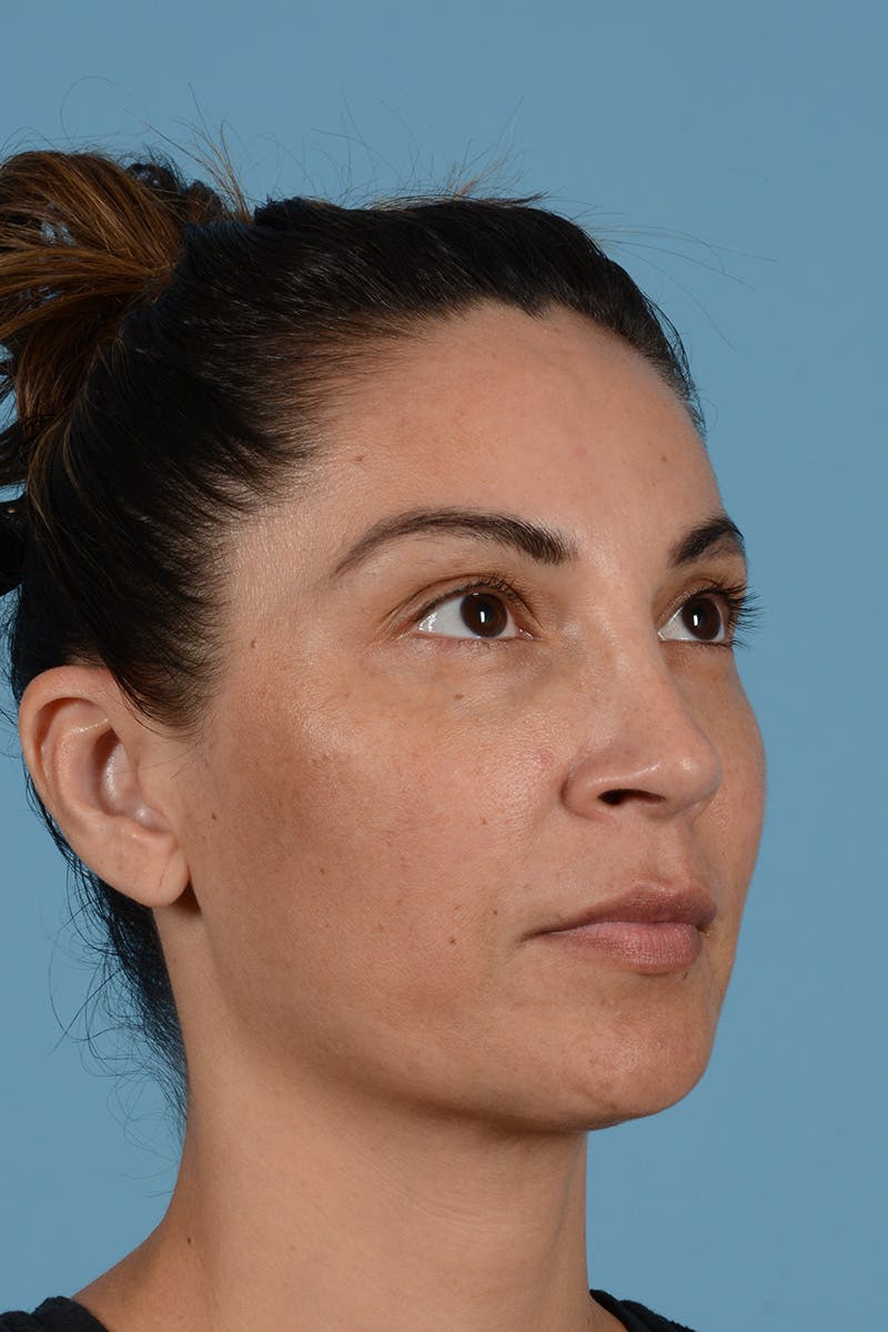 Rhinoplasty Before & After Gallery - Patient 256091 - Image 4
