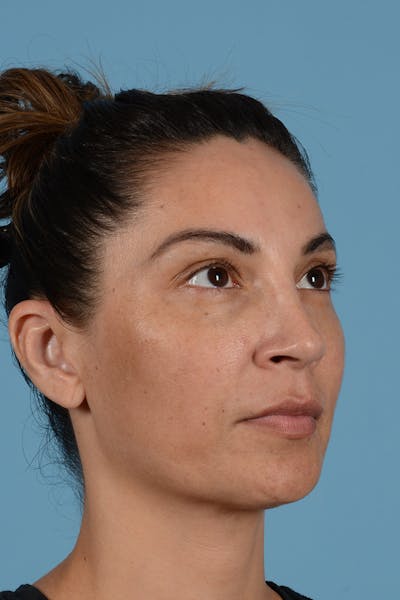 Rhinoplasty Before & After Gallery - Patient 256091 - Image 4