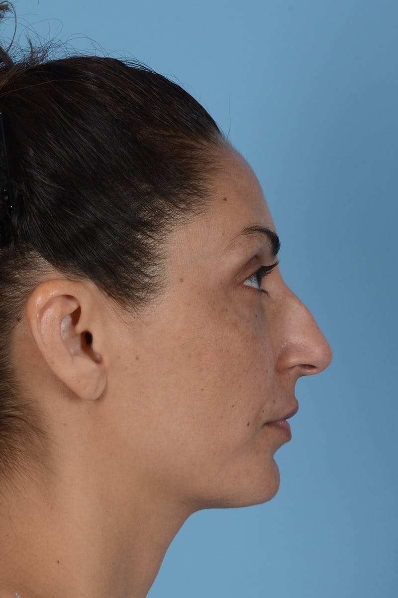 Rhinoplasty Before & After Gallery - Patient 256091 - Image 5