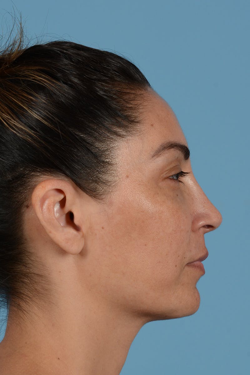 Rhinoplasty Before & After Gallery - Patient 256091 - Image 6