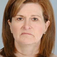 Facelift Before & After Gallery - Patient 268651 - Image 1