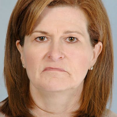 Facelift Before & After Gallery - Patient 268651 - Image 1