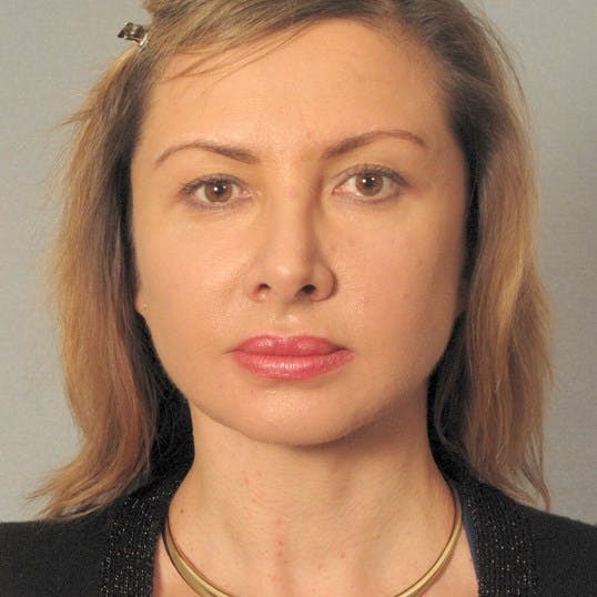 Neck Lift Before & After Gallery - Patient 159363 - Image 2