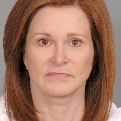 Facelift Before & After Gallery - Patient 268651 - Image 2