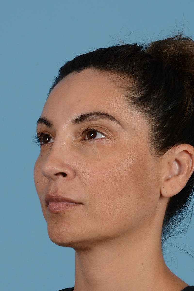 Rhinoplasty Before & After Gallery - Patient 256091 - Image 8