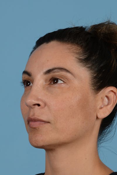 Rhinoplasty Before & After Gallery - Patient 256091 - Image 8