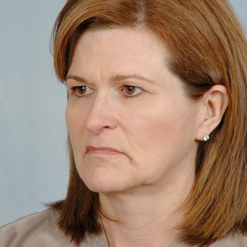 Facelift Before & After Gallery - Patient 268651 - Image 3