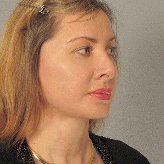 Neck Lift Before & After Gallery - Patient 159363 - Image 4