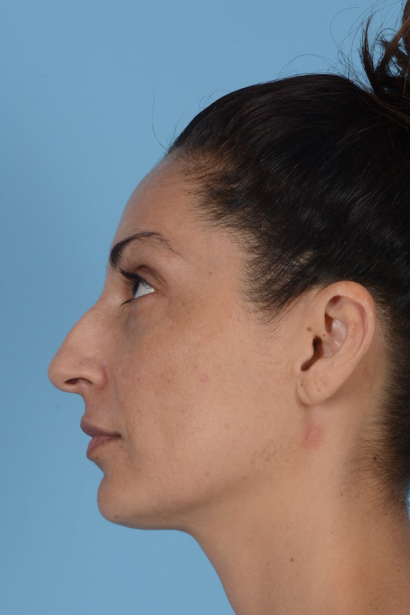 Rhinoplasty Before & After Gallery - Patient 256091 - Image 9