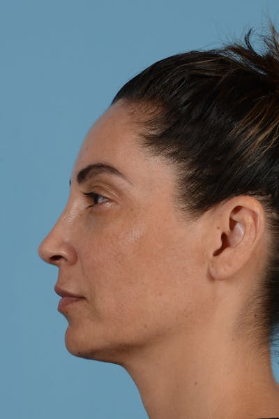 Rhinoplasty Before & After Gallery - Patient 256091 - Image 10