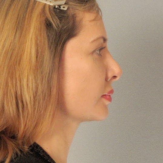 Neck Lift Before & After Gallery - Patient 159363 - Image 6