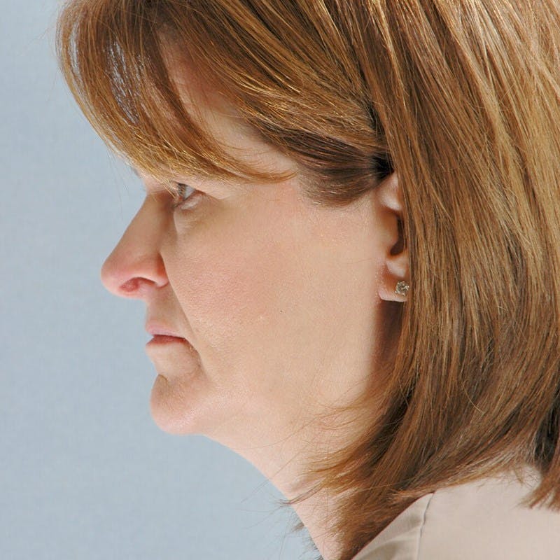Facelift Before & After Gallery - Patient 268651 - Image 5