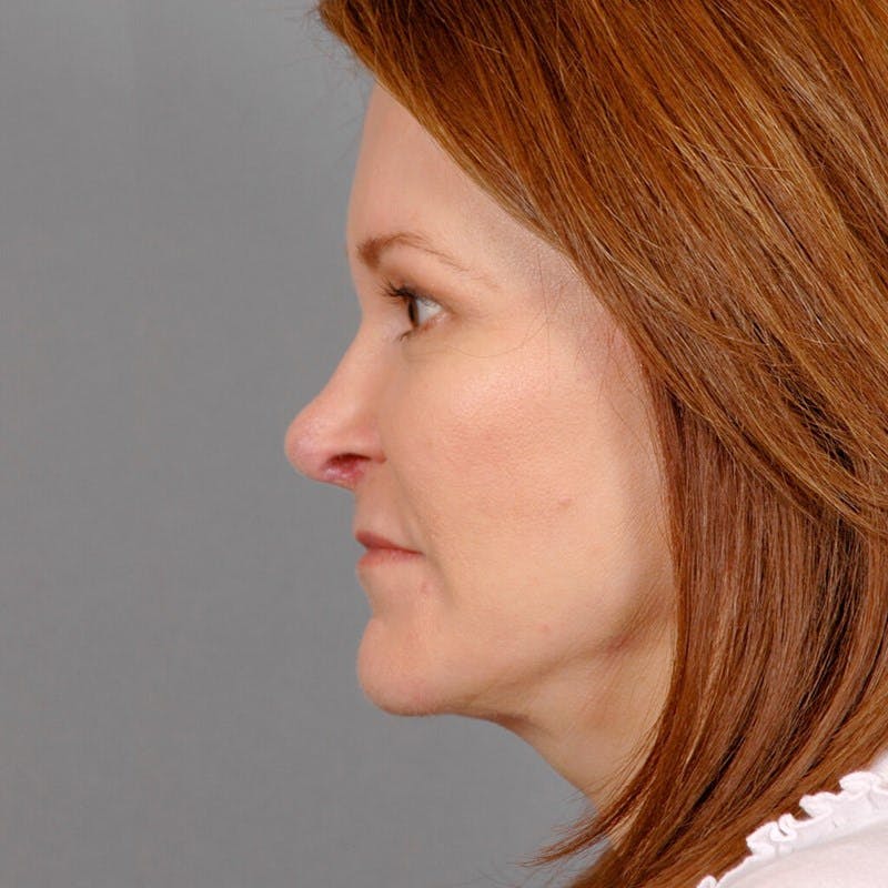 Facelift Before & After Gallery - Patient 268651 - Image 6