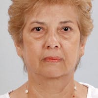 Facelift Before & After Gallery - Patient 264866 - Image 1