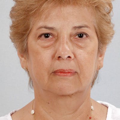 Facelift Before & After Gallery - Patient 264866 - Image 1