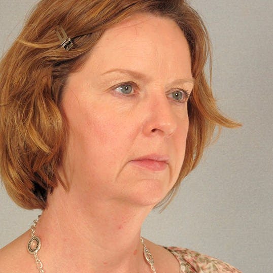 Neck Lift Before & After Gallery - Patient 323705 - Image 3