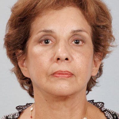 Facelift Before & After Gallery - Patient 264866 - Image 2