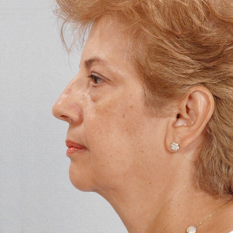 Facelift Before & After Gallery - Patient 264866 - Image 5
