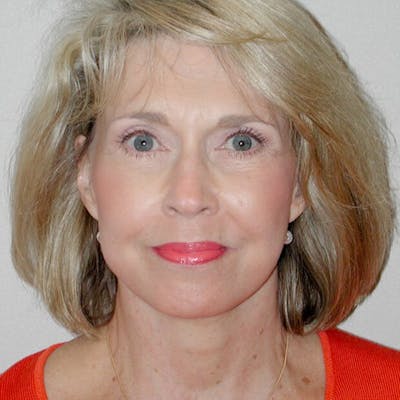 Neck Lift Before & After Gallery - Patient 232869 - Image 2