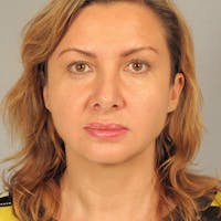 Facelift Before & After Gallery - Patient 778784 - Image 1