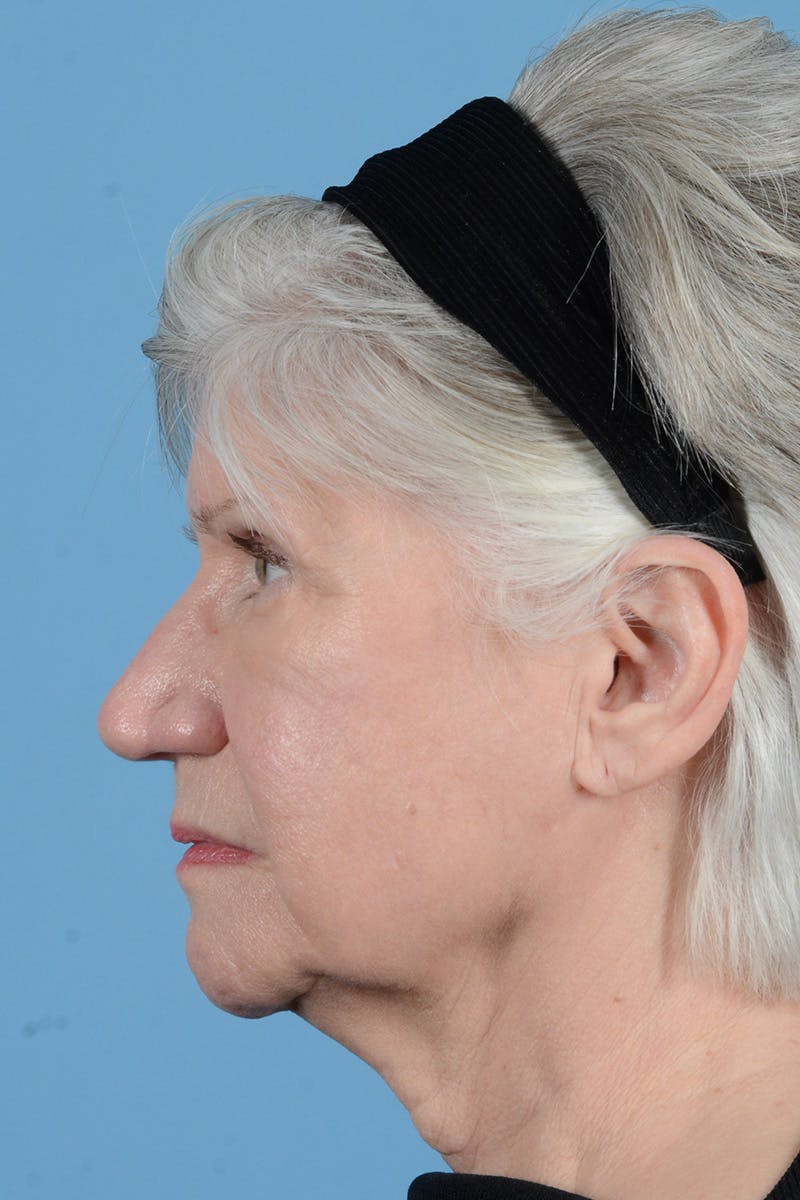 Rhinoplasty Before & After Gallery - Patient 613343 - Image 9