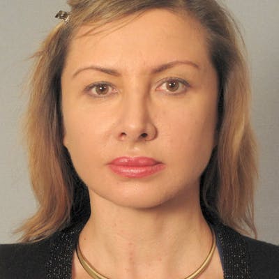 Facelift Before & After Gallery - Patient 778784 - Image 2