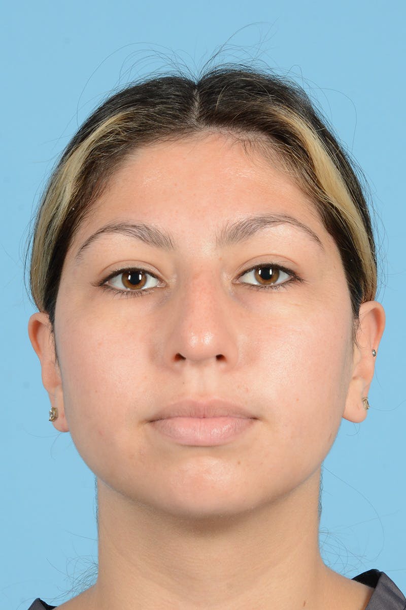 Rhinoplasty Before & After Gallery - Patient 108822 - Image 1