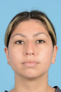 Rhinoplasty Before & After Gallery - Patient 108822 - Image 1