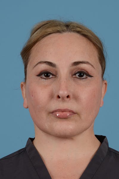 Skin Resurfacing Before & After Gallery - Patient 371664 - Image 2